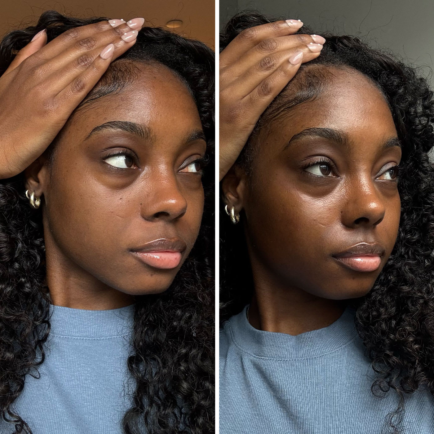 Woman with dark curly hair wearing a blue top, shown before and after treatment. Both photos focus on her face, highlighting changes around the under-eye area.